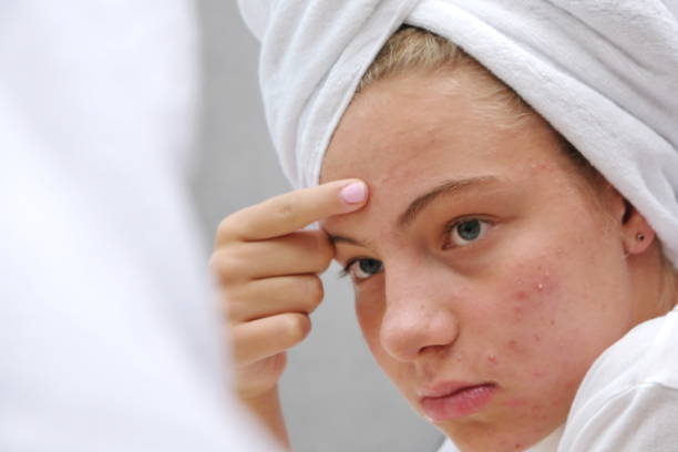 Comedonal Acne Is the Most Mild Form of Acne—Here’s How to Treat It