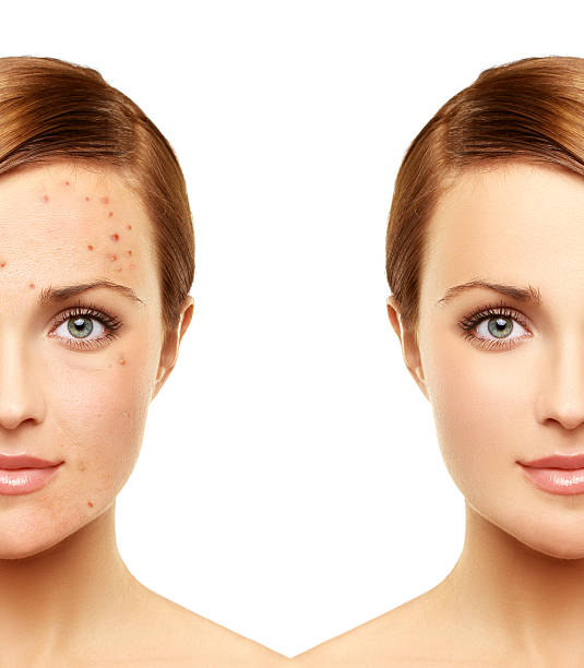 Isolaz: Everything to Know About This Painless Acne Treatment